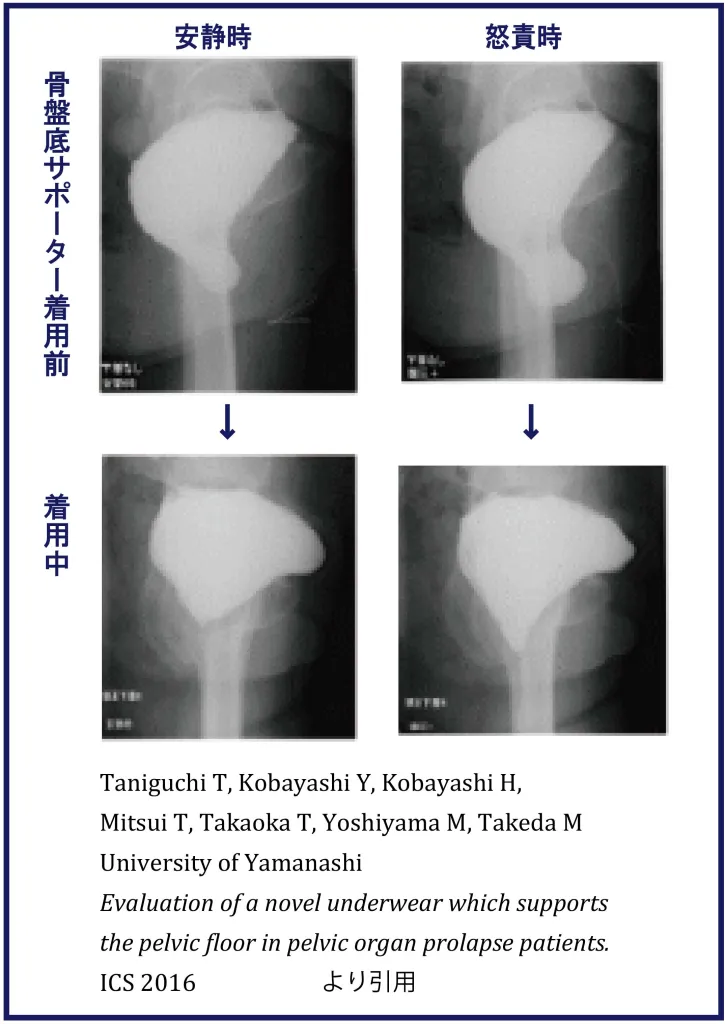 骨盤底サポーターの効果　膀胱造影画像