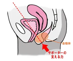 骨盤底サポーター使用時断面図