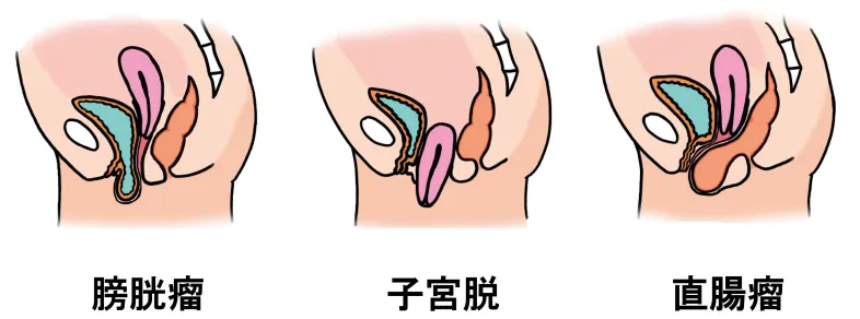 骨盤臓器脱の方の体内の様子のイラスト